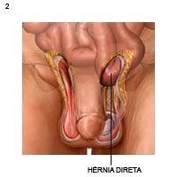 hérnia inguinal
