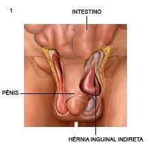 hérnia inguinal