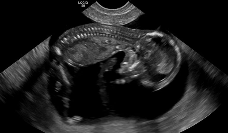 Ultrassom-obstetrico